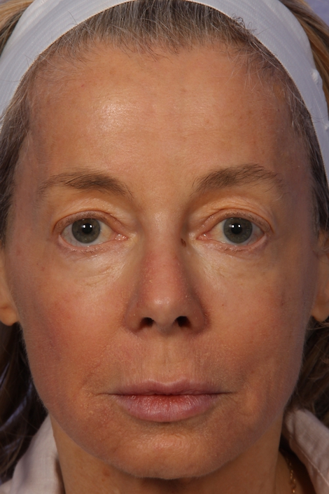 Laser Skin Resurfacing before and after photo