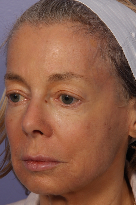 Laser Skin Resurfacing before and after photo