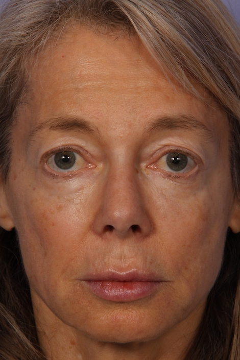 Laser Skin Resurfacing before and after photo