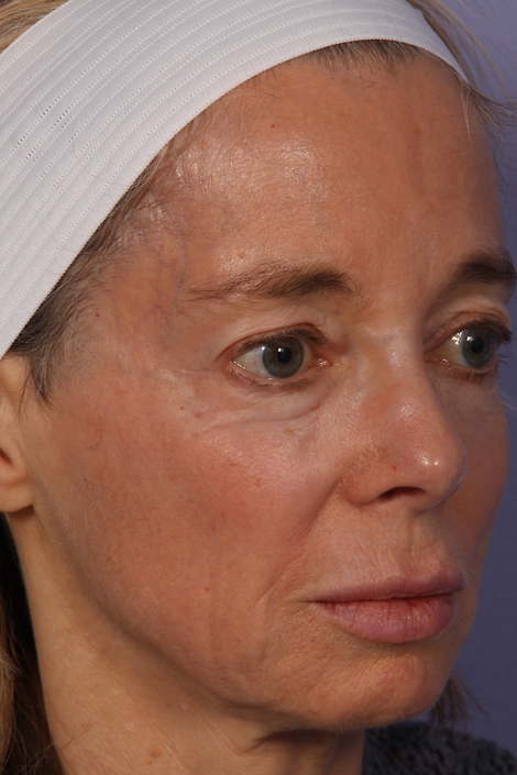 Laser Skin Resurfacing before and after photo