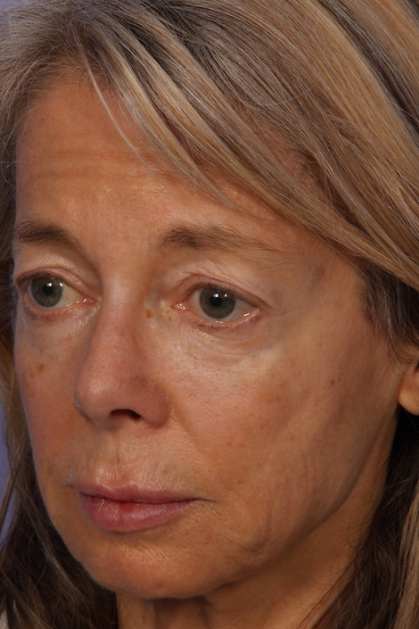 Laser Skin Resurfacing before and after photo