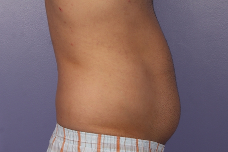 CoolSculpting® before and after photo