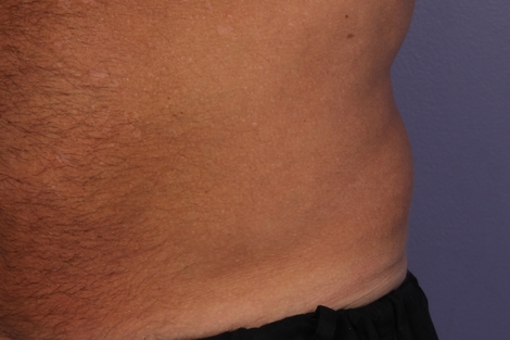 CoolSculpting® before and after photo