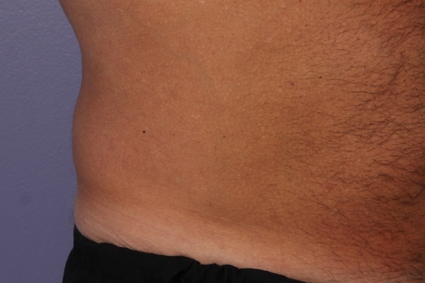 CoolSculpting® before and after photo