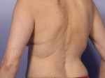 CoolSculpting® Before and after photo