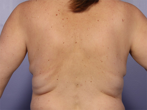 CoolSculpting® before and after photo