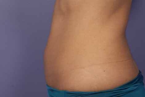 CoolSculpting® before and after photo