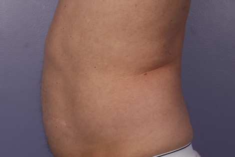 CoolSculpting® before and after photo