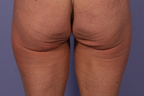 CoolSculpting® before and after photo