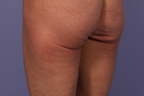 CoolSculpting® before and after photo