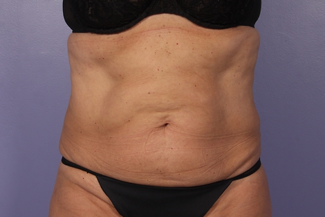 CoolSculpting® before and after photo