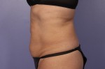 CoolSculpting® Before and after photo