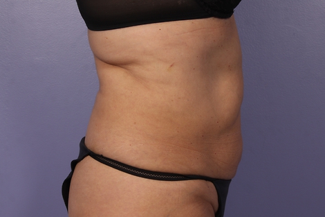 CoolSculpting® before and after photo