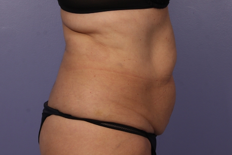 CoolSculpting® before and after photo