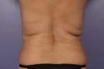 CoolSculpting® Before and after photo