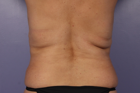 CoolSculpting® before and after photo