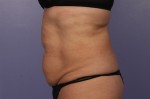 CoolSculpting® Before and after photo