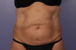 CoolSculpting®