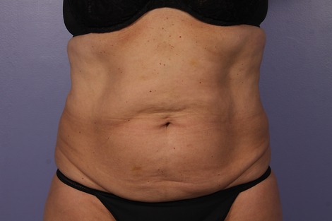 CoolSculpting® before and after photo