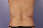 CoolSculpting® Before and after photo