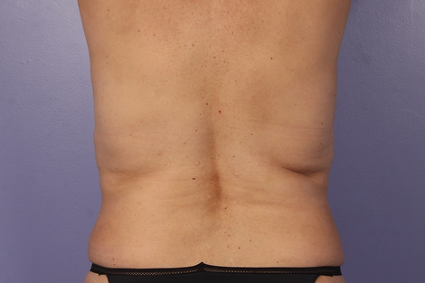 CoolSculpting® before and after photo