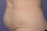 CoolSculpting® Before and after photo