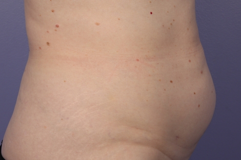 CoolSculpting® before and after photo