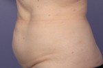 CoolSculpting® Before and after photo