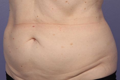 CoolSculpting® before and after photo