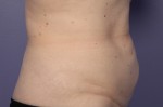 CoolSculpting®