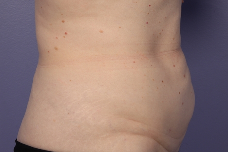 CoolSculpting® before and after photo