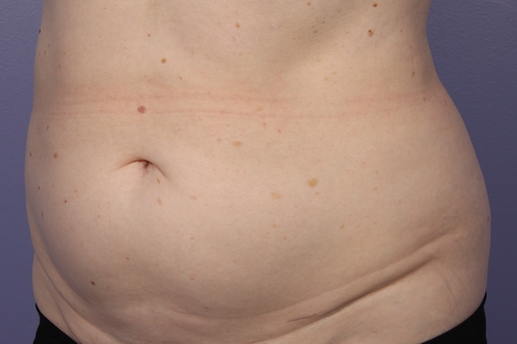 CoolSculpting® before and after photo