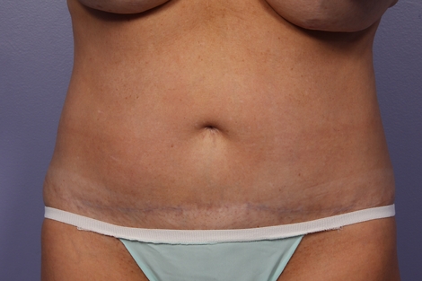 CoolSculpting® before and after photo