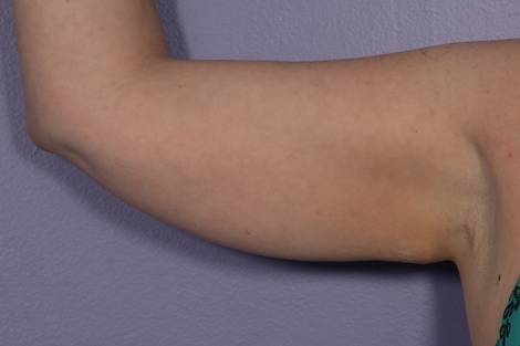 CoolSculpting® before and after photo