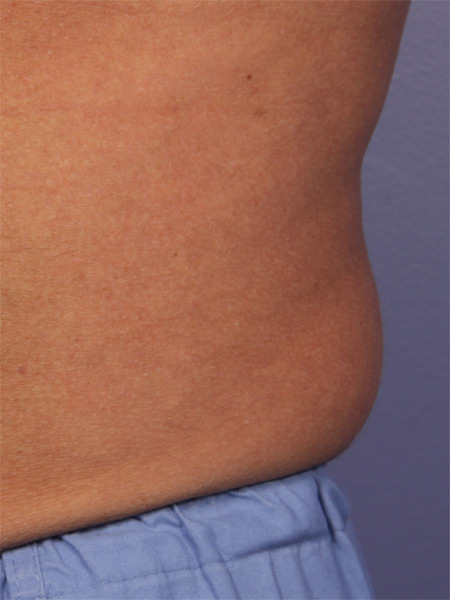 CoolSculpting® before and after photo