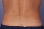 CoolSculpting®