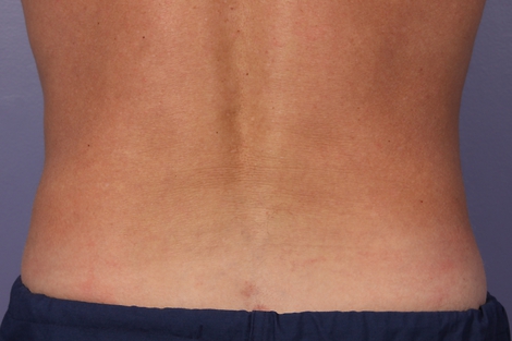 CoolSculpting® before and after photo