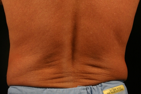 CoolSculpting® before and after photo