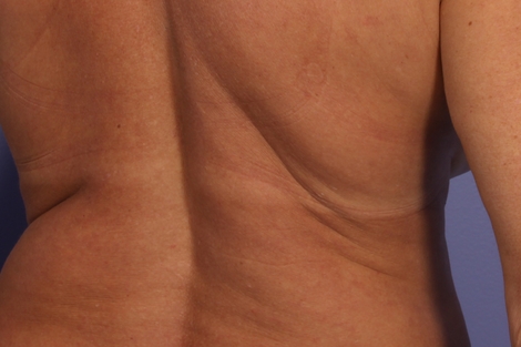 CoolSculpting® before and after photo