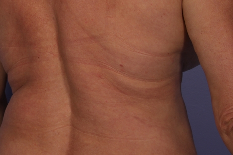 CoolSculpting® before and after photo