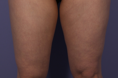 CoolSculpting® before and after photo