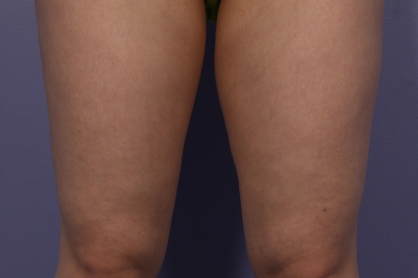 CoolSculpting® before and after photo