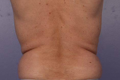 CoolSculpting® before and after photo