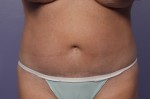 CoolSculpting®