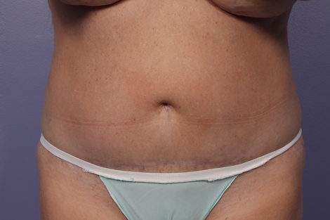 CoolSculpting® before and after photo