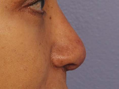 Injectable Fillers before and after photo