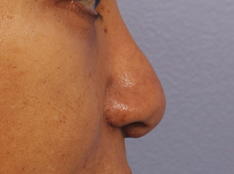 Injectable Fillers before and after photo