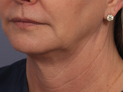 Kybella before and after photo