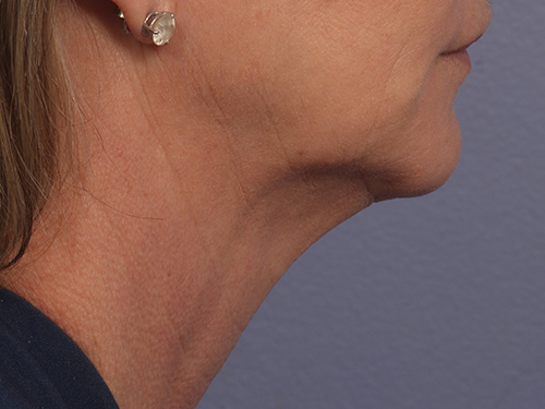 Kybella before and after photo