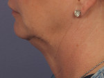 Kybella Before and after photo